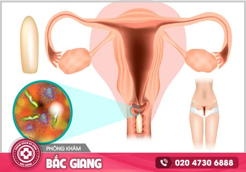 Viêm vùng kín có dấu hiệu ra sao ở nữ giới?